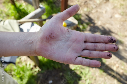 Close up of scraped human hand after fallen on running