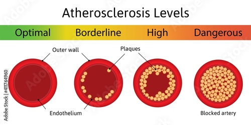 Atherosclerosis levels. The accumulation of cholesterol in the blood vessels. Atherosclerotic plaque. Artery anatomy. Medical vector illustration.