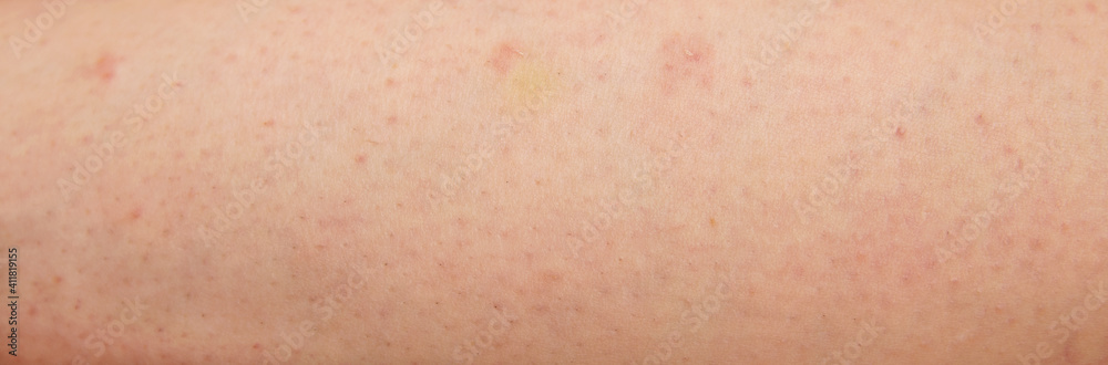 Redness, damage and irritation on white skin from waxing Redness, damage and irritation on white skin from waxing