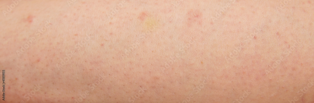 Redness, damage and irritation on white skin from waxing