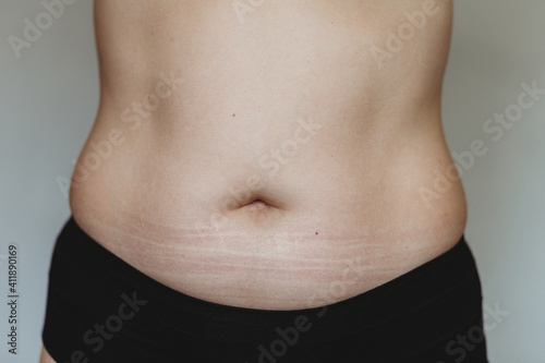 womans belly with stretch marks 
