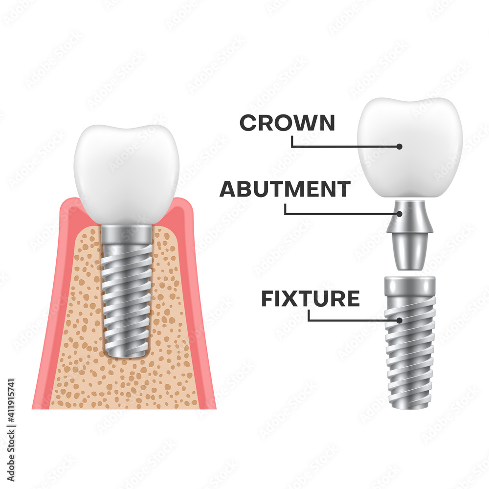 Dental implant structure realistic schematic. Implantation sequence