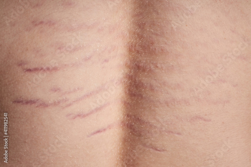 Close up view of the back with striae distensae (striae rubrae) on the skin. The concept of impaired skin elasticity during puberty photo