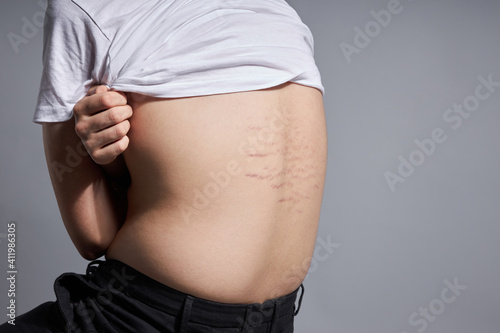 Teenage is showing his back with striae distensae (striae rubrae) on the skin. The concept of impaired skin elasticity during puberty