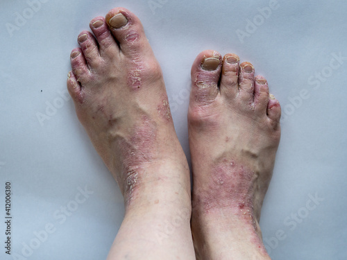 Closeup of the legs of a woman suffering from chronic psoriasis on a white background. Closeup of rash and scaling on the patient's skin. Dermatological problems. Dry skin. Isolated.