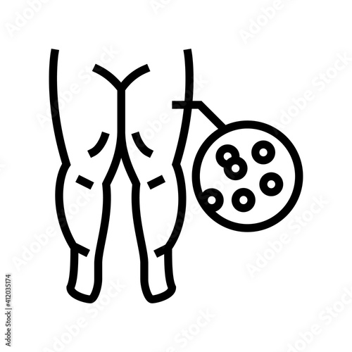hypoproteinemic edema line icon vector. hypoproteinemic edema sign. isolated contour symbol black illustration