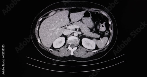 A motion CT scan of an abdomen of a patient with umbilical hernia. photo