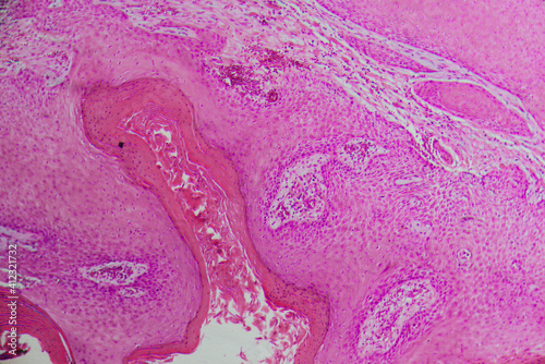 human cells, well differentiated squamous cell carcinomas