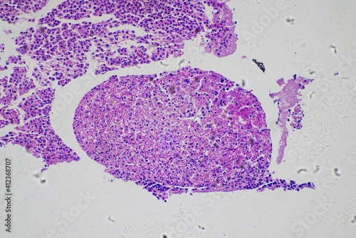 Suppurative inflammation of human appendix