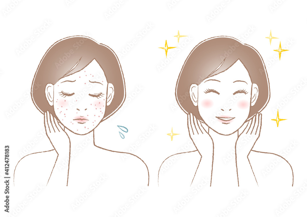 ニキビ 吹き出物に悩む女性のイラスト ビフォーアフター Stock Vector Adobe Stock ニキビ 吹き出物に悩む女性のイラスト ビフォーアフター Stock Vector Adobe Stock