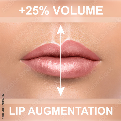 Comparison of female lips after augmentation