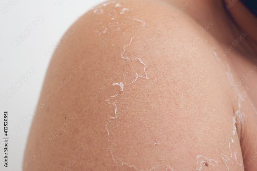 Fototapeta premium Peeling skin at back and shoulder from sunburn effect on body of young man from sunbath at summer. dangerous sunburn concept