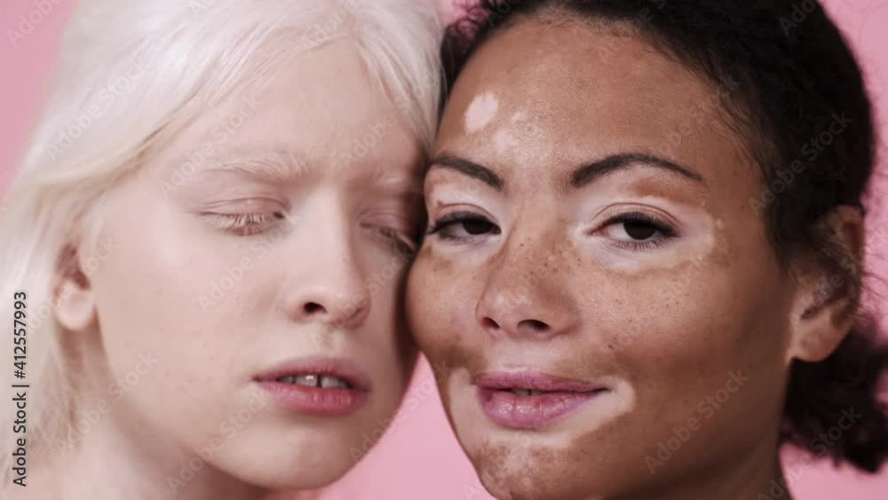 Diverse beauty concepts. Group of women with different kind of skin posing together Diverse beauty concepts. Group of women with different kind of skin posing together