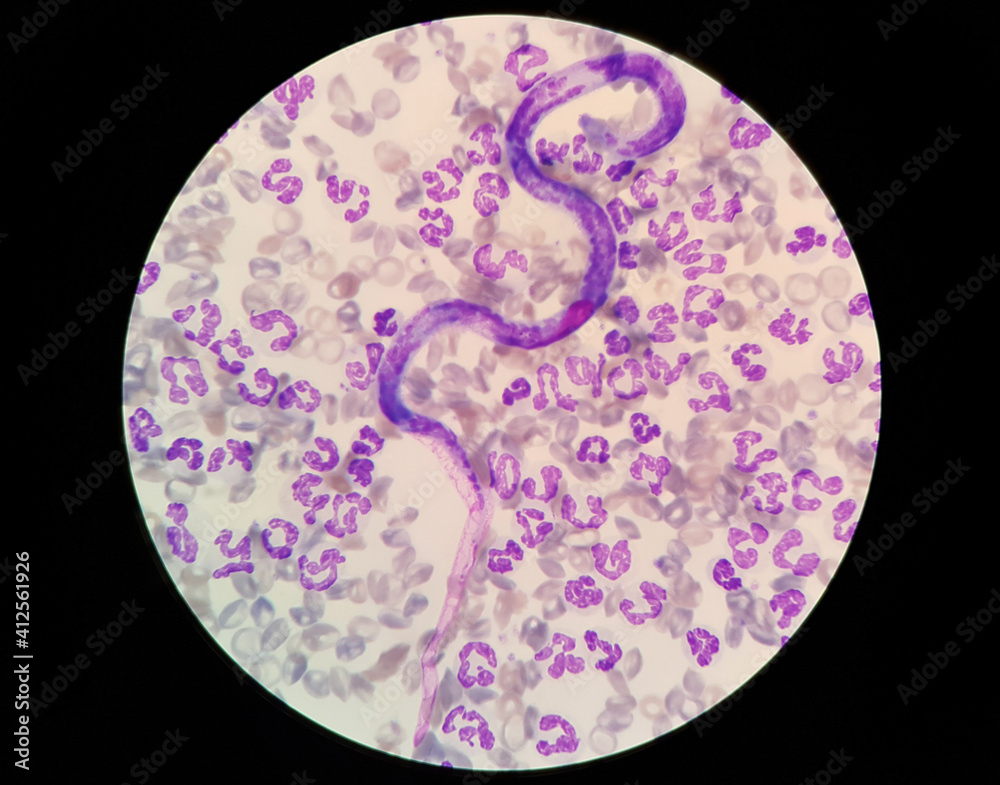 Microfilariae are sheathed in the blood smear of a dog. Light microscope of Brugia spp.
Microfilariae are sheathed in the blood smear of a dog. Light microscope of Brugia spp.