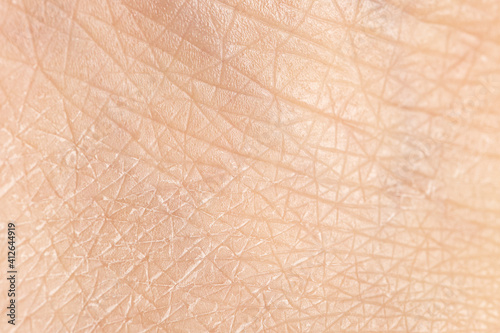 Very dry skin with evident exfoliation, extreme close up of dehydrated human skin