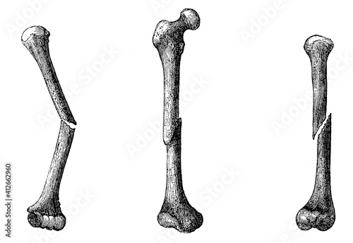 Fracture of the humerus without displacement, fracture of the femur with displacement, fracture of the humerus with displacement and rotation. Illustration of the 19th century. White background.