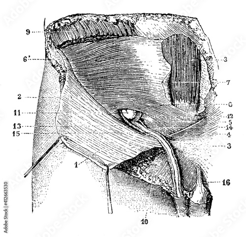 The first appearance of an inguinal hernia. Illustration of the 19th century. Germany. White background. photo