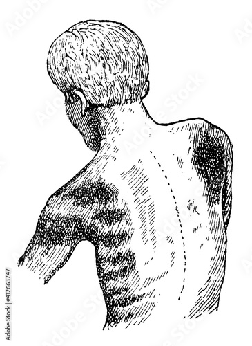 Fototapeta Naklejka Na Ścianę i Meble -  Muscle paralysis of the upper body of a worker due to chronic mercury poisoning. Rear view. Illustration of the 19th century. Germany. White background.