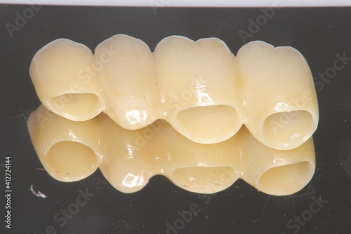 ジルコニア　セラミックブリッジ