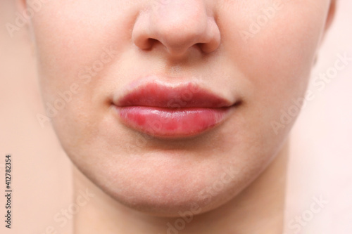 Healing of the lips after enlarging with fillers. photo