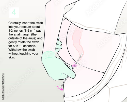 Carefully insert the swab into your rectum about 1-2 inches (3-5 cm) past the anal margin (the outside of the anus) and gently rotate the swab for 5 to 10 seconds.
