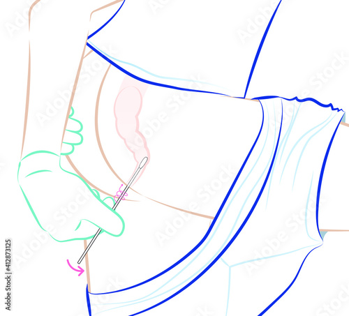 Carefully insert the swab into your rectum about 1-2 inches (3-5 cm) past the anal margin (the outside of the anus) and gently rotate the swab for 5 to 10 seconds.
