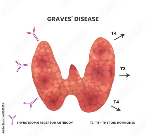 Illustration of the Graves disease causes. Vector scheme showing antibodies binding to the inflamed thyroid causing thyroid to emmit hormones