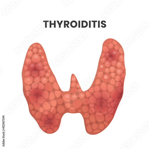 Thyroiditis illustration. vector illustration of the inflamed thyroid gland.