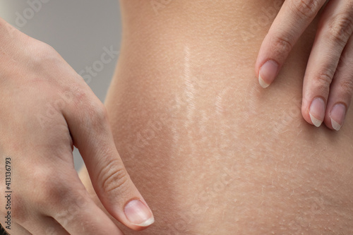 Woman hips with visible stretch marks. Young woman showing Stretch mark scars on her body