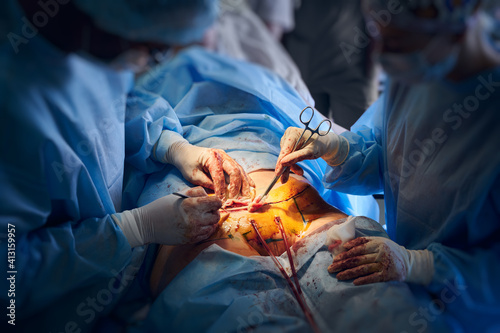 Close up of doctors in surgical suits performing abdominoplasty surgery in clinic. Male plastic surgeon and female assistant doing abdominal plastic surgery. Concept of tummy tuck and cosmetic surgery