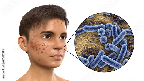 Acne, pimples, and closeup view of bacteria, the causative agents of skin lesions photo
