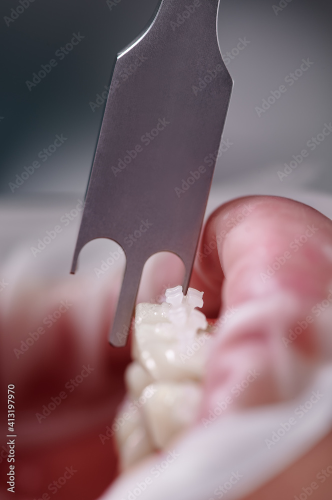 Dental height gauge. Macro photography. Vertical close-up snaphot of a  dental measuring tool, teeth with brackets and lower lip with cheek  retractor. Concept of stomatology, orthodontic treatment фотография Stock |  Adobe Stock