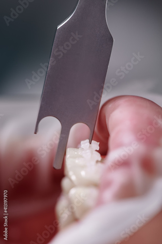 Dental height gauge. Macro photography. Vertical close-up snaphot of a dental measuring tool  teeth with brackets and lower lip with cheek retractor. Concept of stomatology  orthodontic treatment