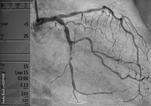 coronary artery angiography ,Coronary artery disease , left coronary angiography photo