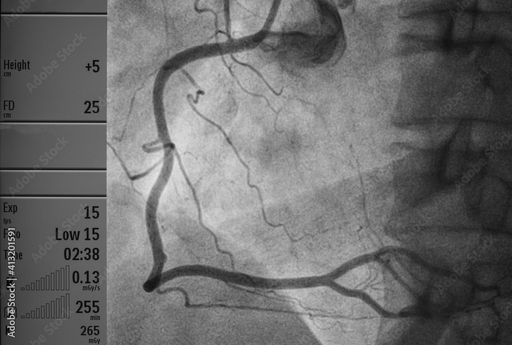 Coronary angiogram , medical x-ray for heart disease. Coronary artery ...