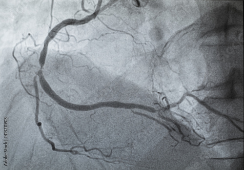 Coronary angiogram , medical x-ray for heart disease. Coronary artery disease. photo