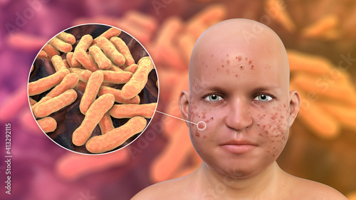 Acne vulgaris in an overweight person and closeup view of bacteria Cutibacterium acnes photo