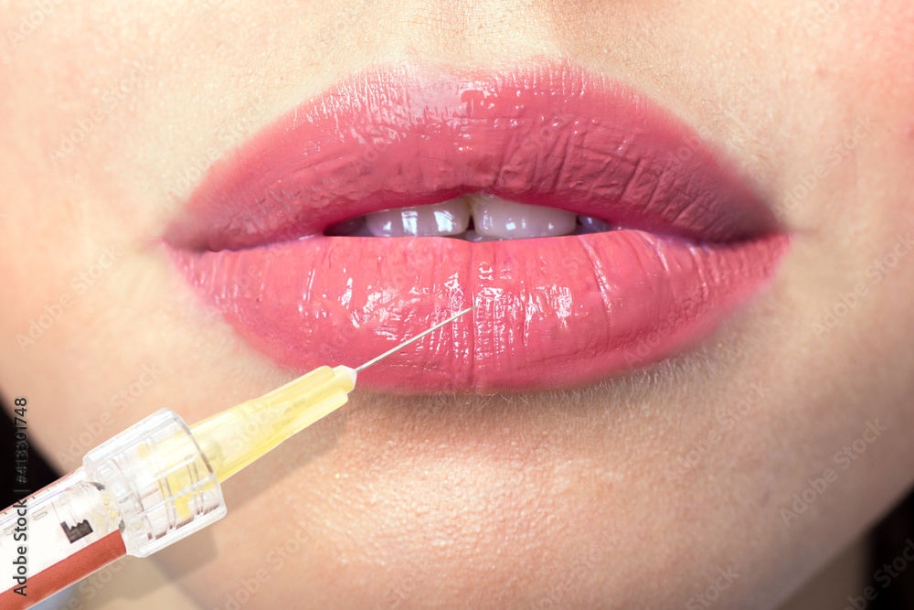 Naklejka premium Cosmetological Injection with a syringe for lip augmentation close-up macro