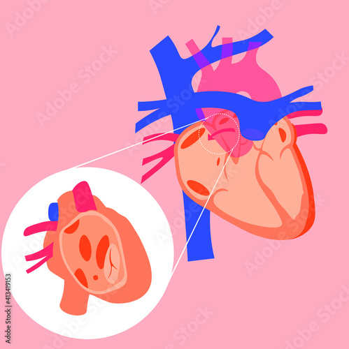 Congenital Heart Disease Type Artery Septal Defect Vector Illustration