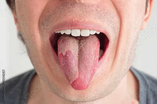 Caucasian male exposed tongue with yeast candida infection unrecognizable close up front view photo