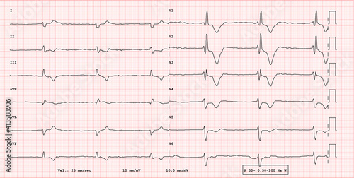 Photos ECG example of a pathological 12-lead rhythm, atrial fibrillation  with total bl