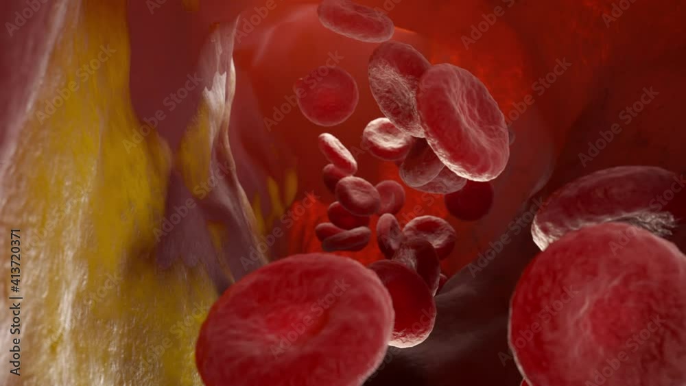 Cholesterol plaque in an artery, Blood vessel with flowing blood cells ...