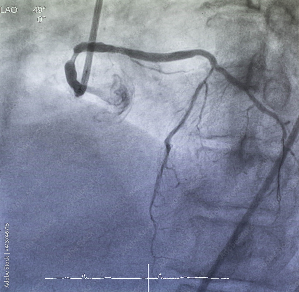 Coronary angiogram , medical x-ray for heart disease. Coronary artery ...