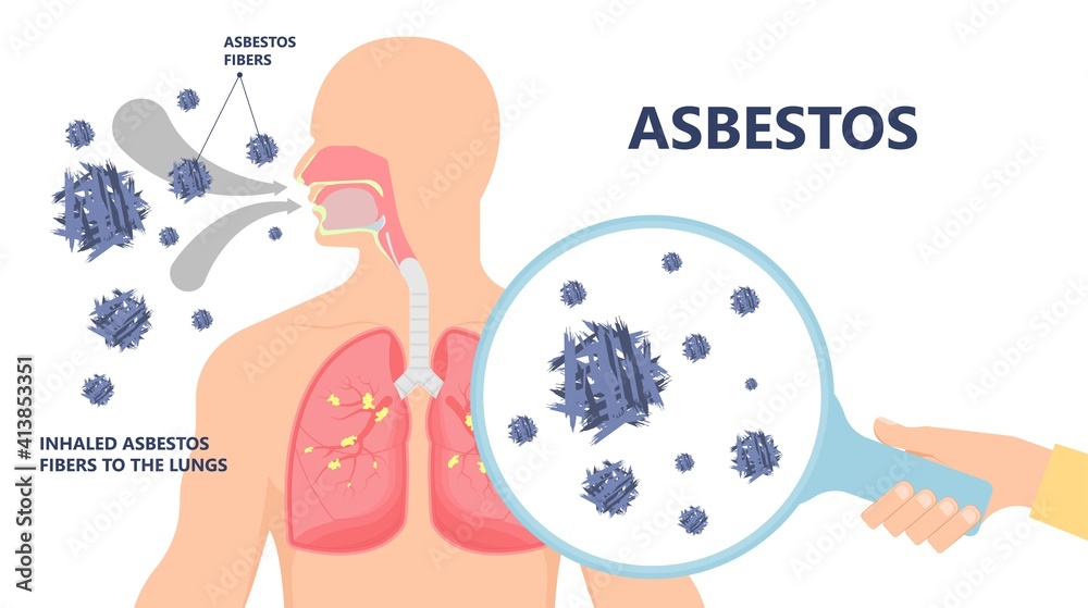 Fototapeta premium Asbestos breath chest pain testes ascites Hydrocele scrotum Swollen Difficulty fluid pleura testicle tunica vaginalis dust tract safe safety carcinogen smoking hazard danger tissue toxic silica copd