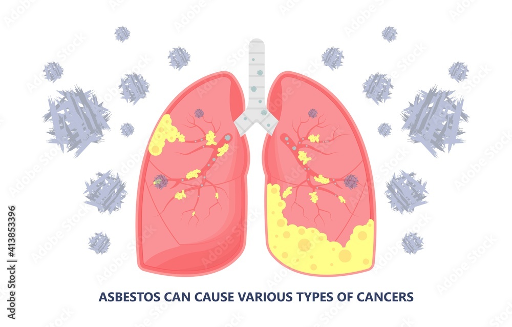 Asbestos Breath Chest Pain Testes Ascites Hydrocele Scrotum Swollen