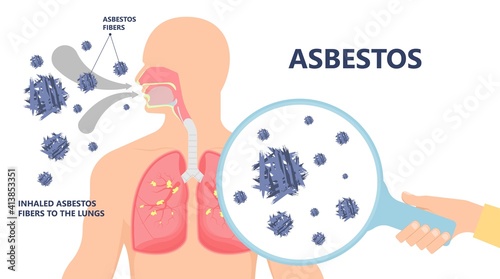 Asbestos breath chest pain testes ascites Hydrocele scrotum Swollen Difficulty fluid pleura testicle tunica vaginalis dust tract safe safety carcinogen smoking hazard danger tissue toxic silica copd