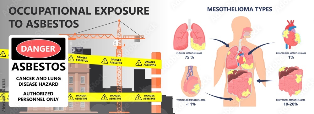 Asbestos Breath Chest Pain Testes Ascites Hydrocele Scrotum Swollen