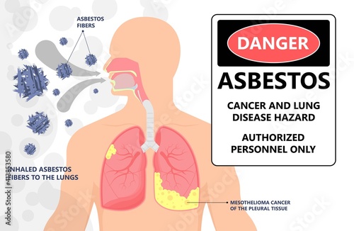 Asbestos breath chest pain testes ascites Hydrocele scrotum Swollen Difficulty fluid pleura testicle tunica vaginalis dust tract safe safety carcinogen smoking hazard danger tissue toxic silica copd