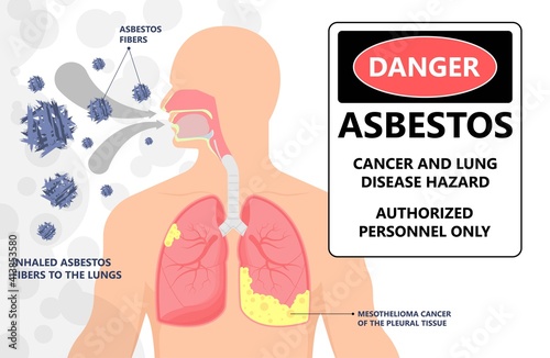 Asbestos breath chest pain testes ascites Hydrocele scrotum Swollen Difficulty fluid pleura testicle tunica vaginalis dust tract safe safety carcinogen smoking hazard danger tissue toxic silica copd