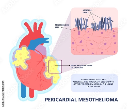 Asbestos breath chest pain testes ascites Hydrocele scrotum Swollen Difficulty fluid pleura testicle tunica vaginalis dust tract safe safety carcinogen smoking hazard danger tissue toxic silica copd